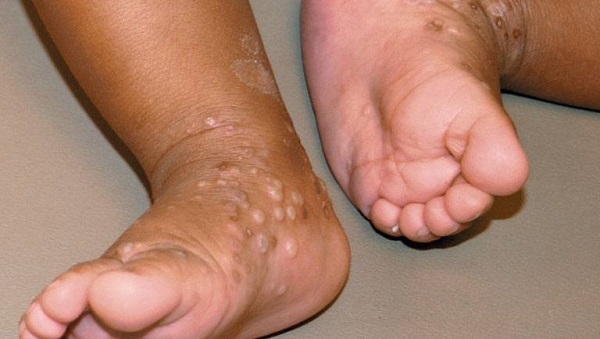 Bệnh tổ đỉa có nguy hiểm không