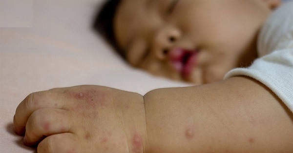 mụn nước do bệnh tay chân miệng