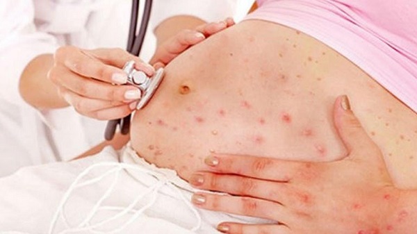 nổi mẩn ngứa do đang mang thai