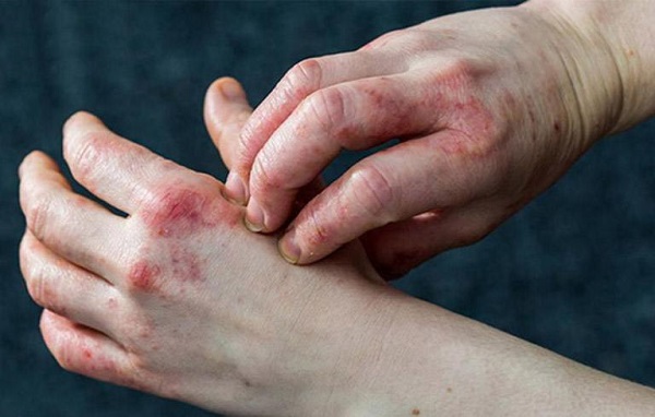 Mụn nước ở tay là bệnh gì? Tổng hợp 20+ cách chữa mụn nước hiệu quả