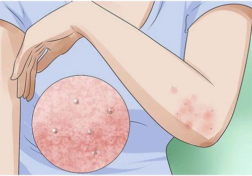 nhung luu y khi dieu tri ghe ngua