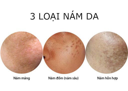 Kem trị nám: TOP 20 sản phẩm hiệu quả trong thời gian ngắn