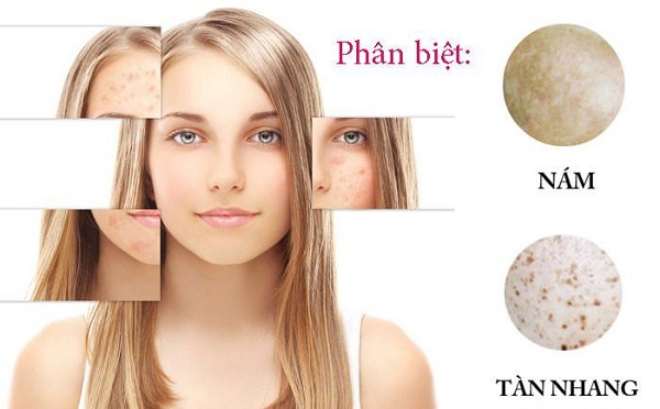 [Tổng hợp] 30+ cách trị nám tàn nhang an toàn và hiệu quả