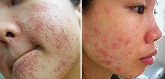 [ Chia sẻ kinh nghiệm] 20+ Cách trị mụn dị ứng tại nhà đơn giản nhất
