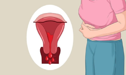 Rong kinh là gì? Bị rong kinh uống gì hết?