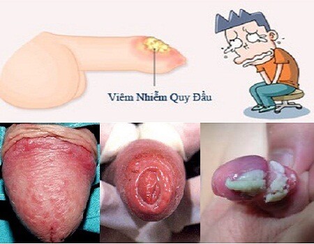 Bệnh viêm bao quy đầu