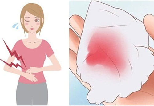 Xuất huyết âm đạo bất thường là dấu hiệu viêm phụ khoa nặng