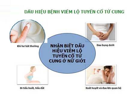 Quan hệ ra dịch trắng như bã đậu – Viêm lộ tuyến cổ tử cung