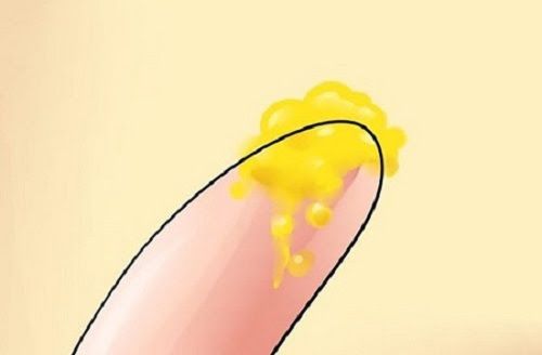 Khí hư màu vàng – Triệu chứng cảnh báo bệnh phụ khoa nguy hiểm