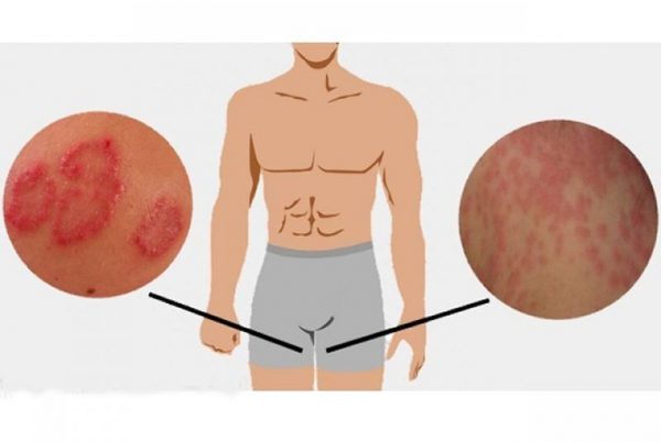 Những thói quen sai lầm hằng ngày gây ngứa vùng kín