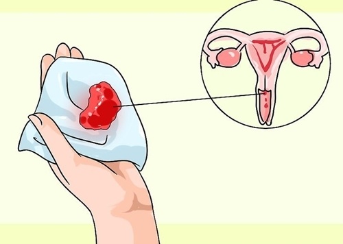 Bị rong kinh uống gì hết? Tổng hợp 30+ cách chữa rong kinh hiệu quả