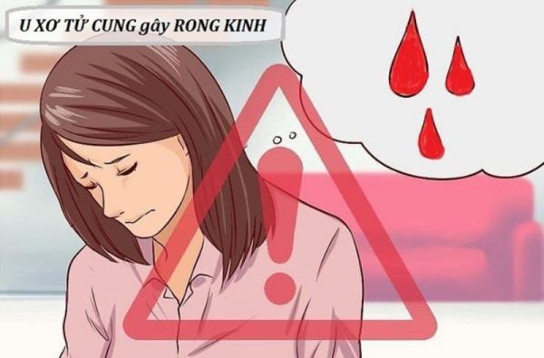 Rong kinh là gì - Dấu hiệu bệnh u xơ tử cung