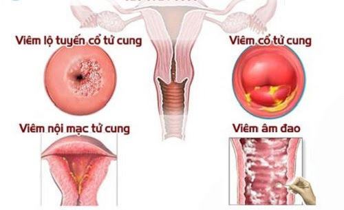 U xơ tử cung