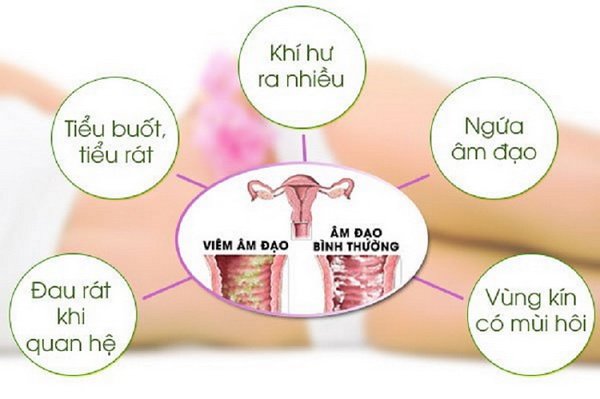 Viêm nhiễm phụ khoa là gì?