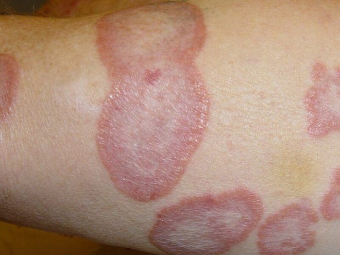 lác đồng tiền là bệnh gì?