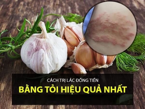 mẹo chữa lác đồng tiền tại nhà