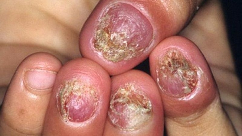 nấm móng tay
