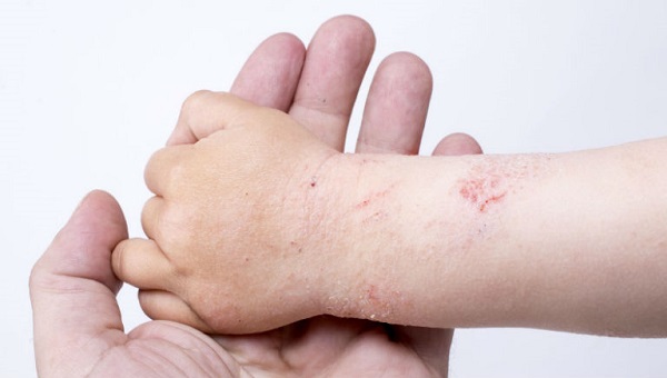 ngứa lòng bàn tay