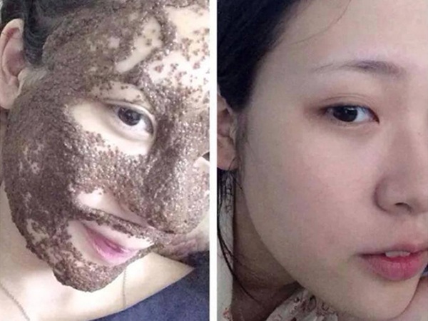 trị mụn bừng hạt đình lịch