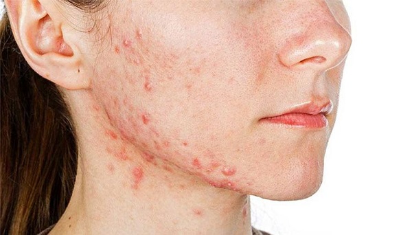 Da mặt bị mụn ngứa là bệnh gì