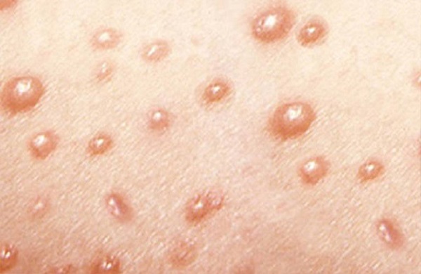 Mụn nước là gì