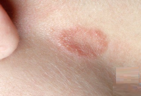 [Nấm bẹn] Nguyên nhân, triệu chứng và cách điều trị