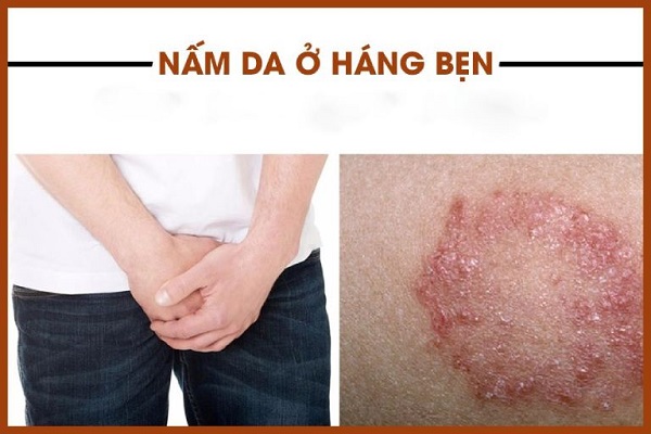 Nấm bẹn có nguy hiểm không