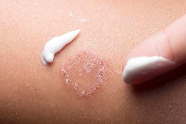 Cách điều trị bệnh nấm bẹn tại nhà