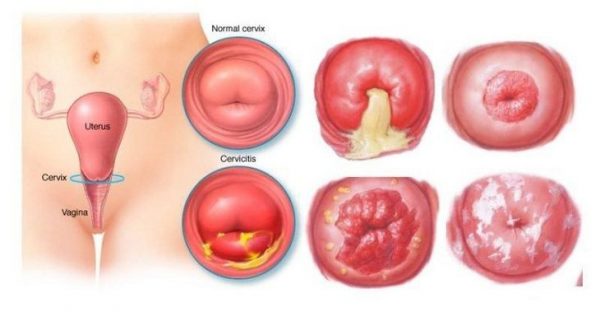Khí hư vón cục – Cảnh báo nhiều bệnh lý nguy hiểm?