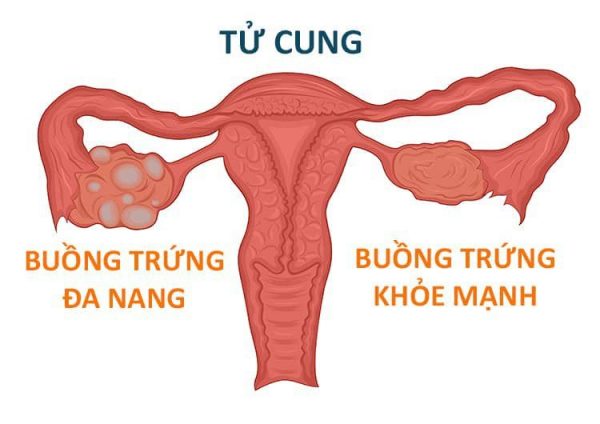 Hội chứng buồng trứng đa nang (PCOS)