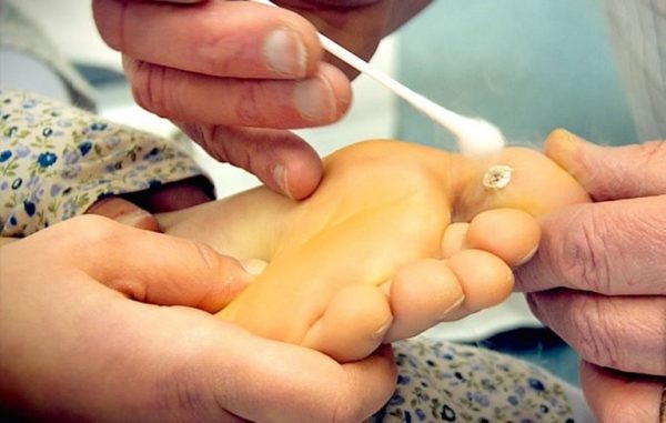 cách chữa mụn cóc
