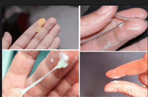 Hình ảnh khí hư bất thường ở nữ giới