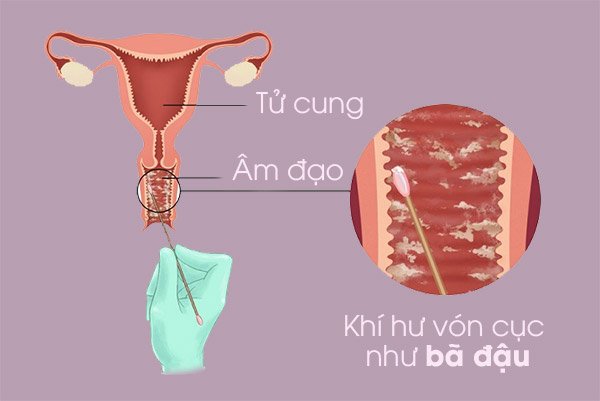 Khí hư màu trắng đục như bã đậu do viêm âm đạo