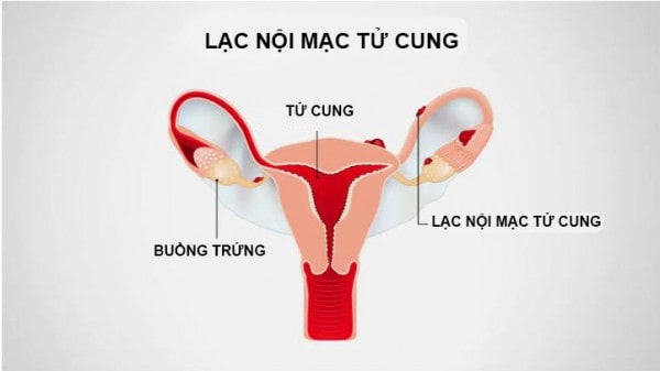 Khí hư có 1 ít sợi máu do lạc nội mạc tử cung