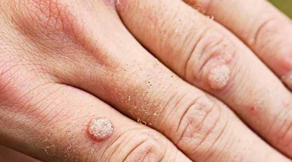 mụn cóc là gì