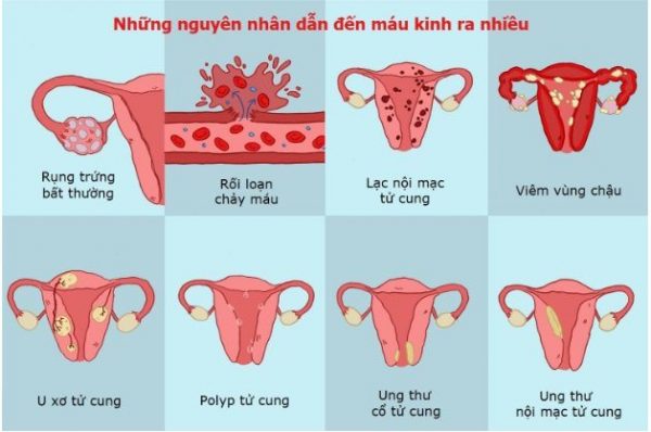 Nguyên nhân kinh nguyệt ra nhiều là gì?