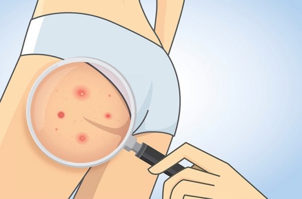 thế nào là mụn nhọt ở mông