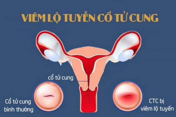 viêm lộ tuyến cổ tử cung