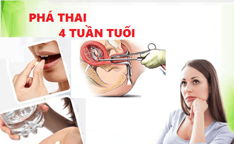 Phá thai 4 tuần tuổi và những điều chị em nên biết