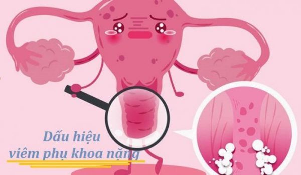 [Chị em nên biết] Viêm phụ khoa nặng và 10+ thông tin nên biết