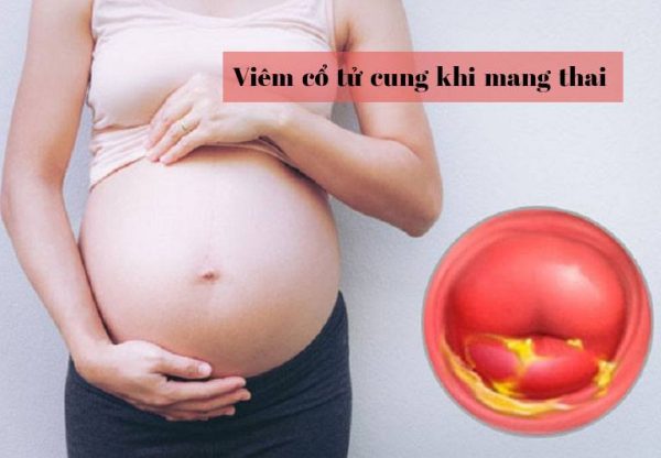 Viêm cổ tử cung nặng khi mang thai: Dấu hiệu và cách phòng tránh