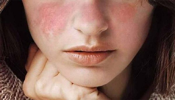 Da mặt bị ngứa có chữa được không?