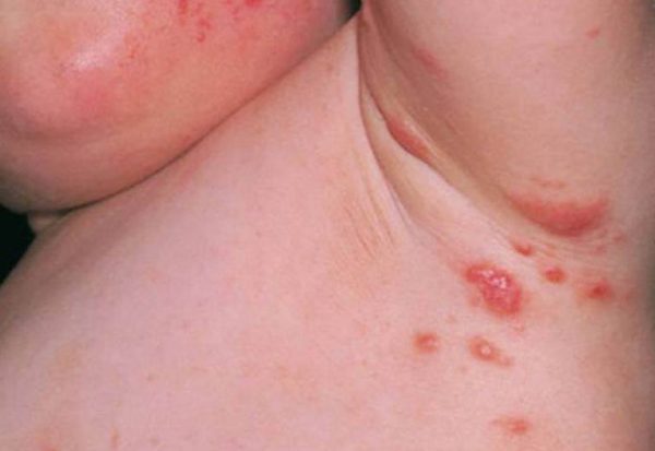 bệnh ghẻ phỏng là gì