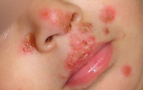 Bệnh ghẻ phỏng ở trẻ em: Dấu hiệu, nguyên nhân và cách điều trị