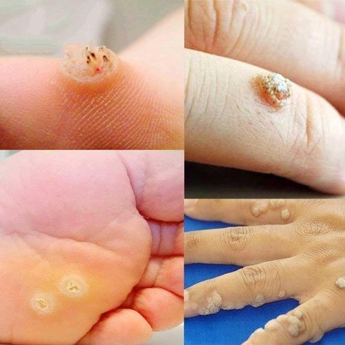 Mụn cóc – Một trong các loại mụn thường gặp nhất