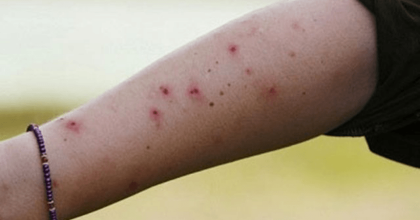 [Chia sẻ] Cách xử trí nhanh khi bị côn trùng cắn sưng to và ngứa