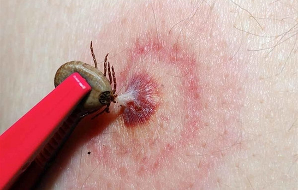 Xử lý như thế nào khi bị côn trùng cắn sưng to và đau