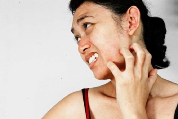 Da mặt bị ngứa là bệnh gì? Và cách điều trị tại nhà hiệu quả