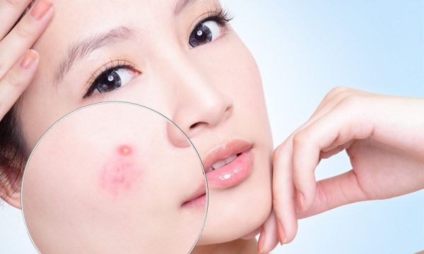 [Tìm hiểu] Dấu hiệu, nguyên nhân gây mụn bọc + Cách điều trị hiệu quả
