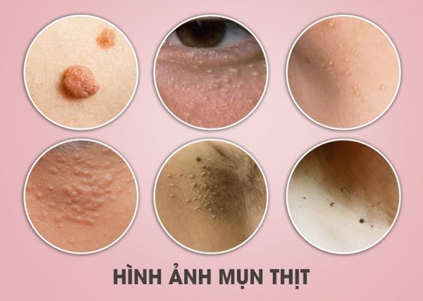 Bạn đã biết mụn thịt là gì chưa?